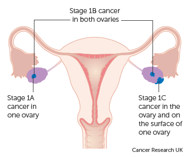 Diagram-showing-stage-1-ovarian-cancer