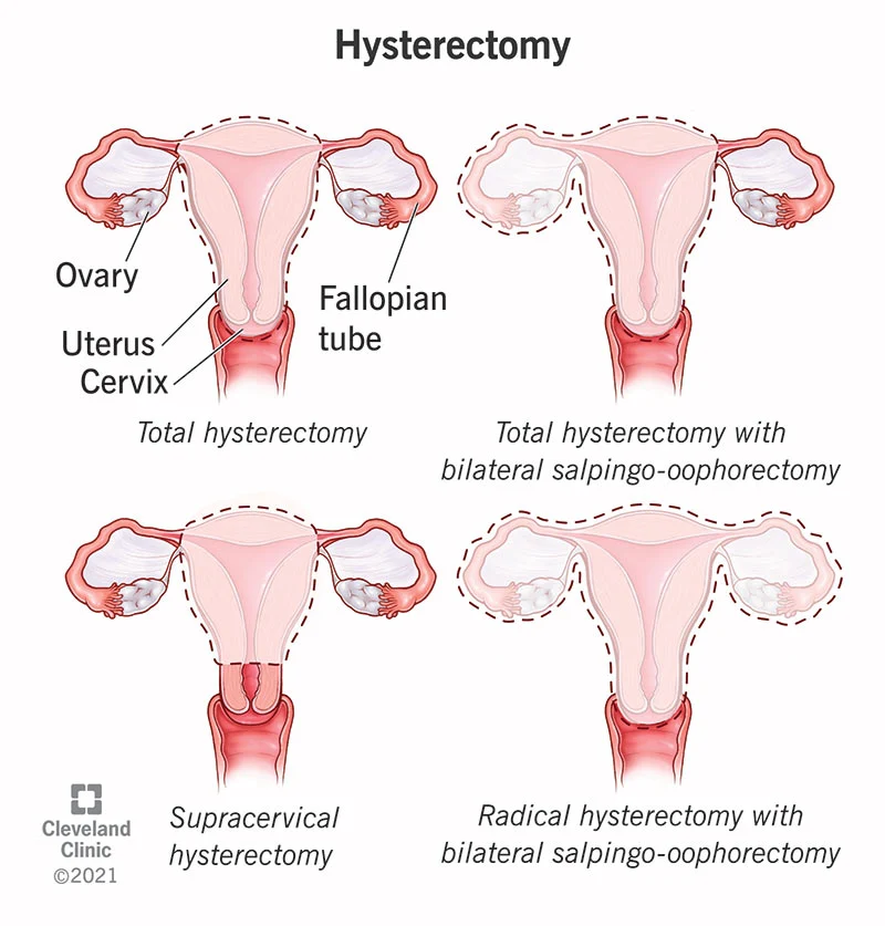 Histerectomía abdominal: recuperación