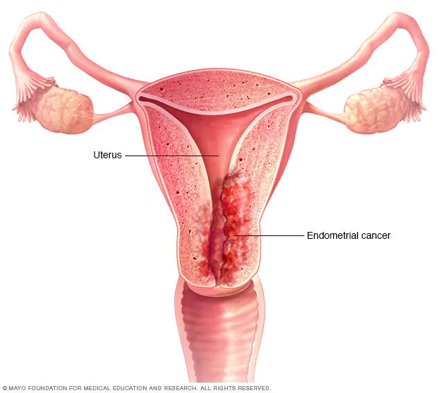 Endometrial Cancer Specialist in Long Island New York